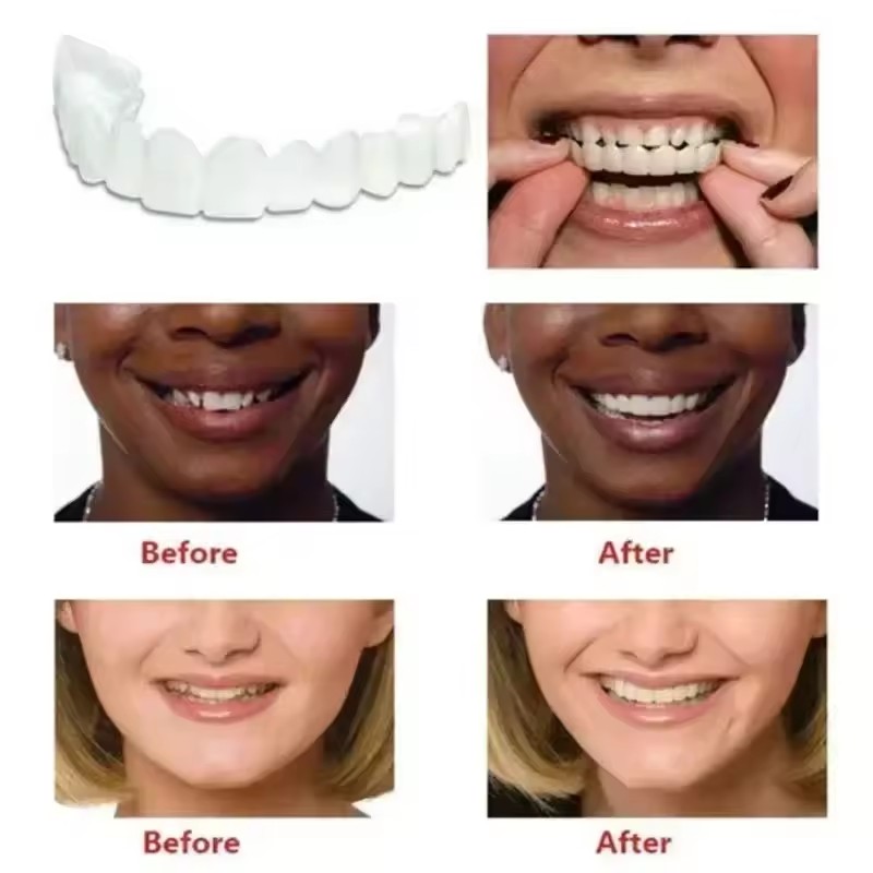 Teeth Veneers Whitening Dentur - Teeth Whitening For Braces review and price