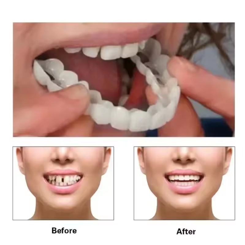 Teeth Veneers Whitening Dentur - Teeth Whitening For Braces review and price